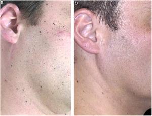 Imagens de seguimento clínico. (A), Múltiplas pequenas máculas enegrecidas na face e no pescoço. (B), Sete anos depois, a maioria dos nevos de Spitz regrediu completamente.