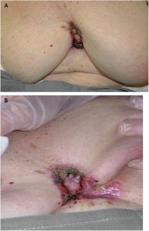 (A e B), Imagem clínica. Uma placa eritematosa‐ purpúrica infiltrada, medindo 6 × 4cm no sulco mamário mediano, espalhando‐se tanto para os sulcos inframamários quanto para o abdômen superior.