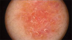 Lesão de cor laranja‐rosada com formação de escamas, especialmente perifolicular, sem padrão de lesão melanocítica ou vascular.