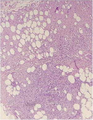 Corte histológico corado em Hematoxilina & eosina mostra tecido adiposo subcutâneo com infiltrado inflamatório granulomatoso.