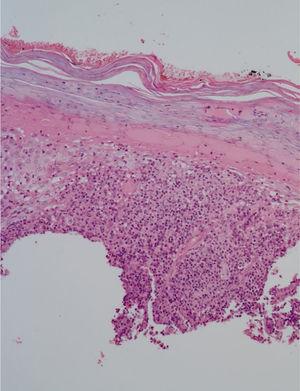 Epiderme com hiper e paraceratose, denso infiltrado inflamatório linfo‐histioplasmocitário na derme, esboçando granulomas e numerosos neutrófilos (Hematoxilina & eosina, 10×).