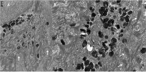 Microscopia eletrônica de transmissão. (A), Queratinócito basal com hemidesmossomos e membrana basal normal (setas; 30.000×). (B), Grande quantidade de melanossomas heterogêneos com tamanho normal e desmossomos normais (setas; 30.000×).