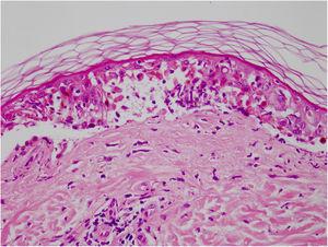 Vacuolização das células basais e clivagem subepidérmica observadas na biópsia (Hematoxilina & eosina, 100×).