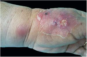 Esporotricose cutâneo‐linfática. Cancro de inoculação esporotricótico no dorso da mão direita.