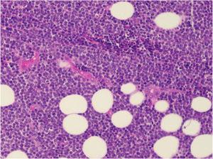 Linfoma não Hodgkin de grandes células infiltrando o linfonodo inguinal com extensão ao tecido adiposo perilinfonodal (Hematoxilina & eosina, 200×).