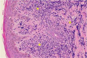 Histopatológico de fragmento cutâneo da coxa. Linfócitos neoplásicos (*) infiltrando difusamente a derme (Hematoxilina & eosina, 200×).