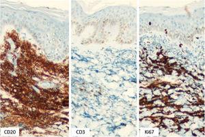 Imuno‐histoquímica de fragmento cutâneo (200×): células neoplásicas difusamente positivas para CD20 e com alto índice proliferativo (Ki67), além de raras linfócitos “T” residuais não neoplásicas CD3+ (Imunoperoxidase, 200×).