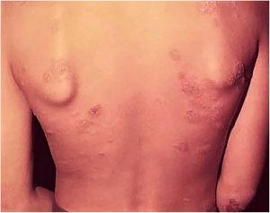 Tuberculose cutânea pós‐BCG – lesões anulares disseminadas no tronco e membros superiores.