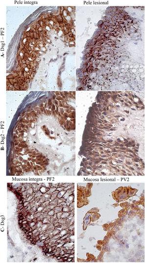 Painel de imuno‐histoquímica com expressões de Dsg1, Dsg2 e Dsg3 em amostras de pele e mucosa de pacientes com PF e PV. A, Dsg1 em amostras de pele íntegra e lesional do paciente PF2 mostrando grânulos conspícuos intercelulares e intracitoplasmáticos (internalização da Dsg1), amplamente distribuídos na pele lesional (amplificação original de 100×). B, Dsg2 comparando amostra de pele íntegra e lesional do paciente PF2, confirmando a ausência de grânulos (amplificação original de 100×). C, Dsg3 comparando amostra de mucosa íntegra do paciente PF2 e mucosa lesional do paciente PV3, mostrando grânulos finos intercelulares e intracitoplasmáticos (internalização da Dsg3) na mucosa lesional (amplificação original de 100×).