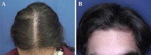 Padrões de queda de cabelos observados na alopecia androgenética pediátrica. (A), Afinamento difuso na região da coroa com preservação da linha frontal capilar em uma paciente do sexo feminino com alopecia androgenética na adolescência. (B), Preservação da linha frontal capilar em um paciente do sexo masculino com alopecia androgenética na adolescência apresentando afinamento difuso na região da coroa.