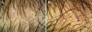 Achados tricoscópicos da alopecia androgenética pediátrica. (A e B), Variação no diêmetro dos fios de cabelo e unidades pilossebáceas com pelo único. (A), Descoloração perifolicular (setas brancas). (B), Pelos ondulados (setas brancas), pelos em círculos (setas amarelas), vasos puntiformes e em vírgula (setas pretas).