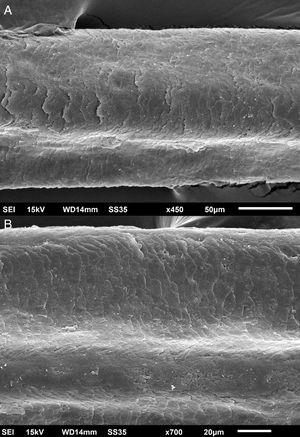 Microscopia eletrônica de varredura – exame dos cílios. (A), Grande aumento, mostrando canais na haste pilar e irregularidade da cutícula (450×). (B), Grande aumento, mostrando dois canais na haste pilar – setas (700×).