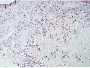 Proliferação de pequenos vasos mais intensa na derme superior com extensão para derme média (Hematoxilina & eosina, 200×).