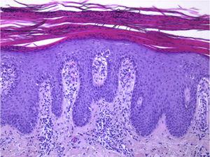Aspectos histopatológicos da psoríase gutata (caso 1) (Hematoxilina & eosina, 100×). Hiperplasia psoriasiforme da epiderme, com neutrófilos no interior de paraceratose contínua e microabscessos intracórneos; ausência de estrato granuloso; papilomatose com hiperplasia vascular e infiltrado linfocítico perivascular na derme superficial.