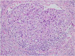Carcinoma sebáceo extraocular. Neoplasia caracterizada por células claras poligonais, pleomorfismo nuclear, restos celulares e frequentes figuras de mitose (Hematoxilina & eosina, 40×).