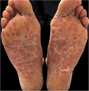 Máculas e pápulas purpúricas eritematosas e bolhas isoladas, localizadas nos pés.