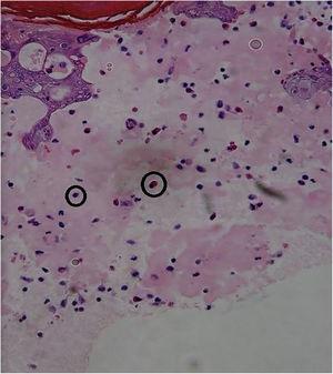 Observa‐se a formação de bolhas serosas com eosinófilos e linfócitos. Derme papilar edemaciada com infiltração perivascular mononuclear (Hematoxilina & eosina, 400×).