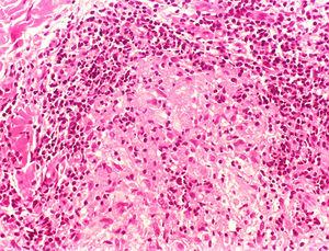Hanseníase tuberculoide. Granuloma epitelioide, bem organizado com halo periférico denso composto principalmente por linfócitos. (Hematoxilina & eosina, 200×).