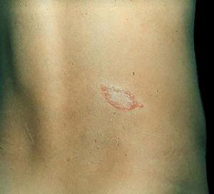 Hanseníase tuberculoide. Placa bem‐delimitada por pápulas eritematosas e centro hipocrômico.