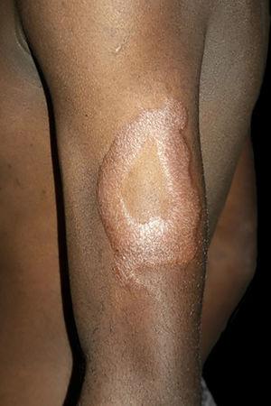 Hanseníase dimorfa – tuberculoide. Placa eritemato‐endurada, foveolar, bordas internas e externas nítidas.