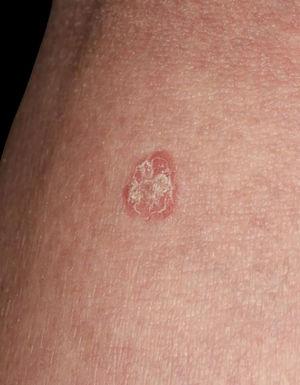 Detalhe da lesão mostrando lesão eritematosa circunscrita, levemente elevada, com escamas.