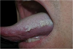 Placa esbranquiçada com projeções filiformes aderidas na borda lateral esquerda da língua.
