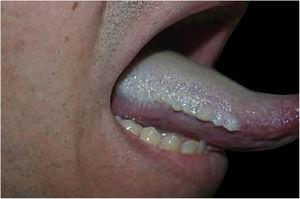 Placa esbranquiçada com projeções filiformes aderidas na borda lateral direita da língua.