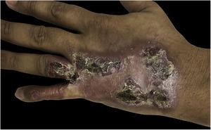Placa eritematosa de aspecto verrucoso, com nódulos e crostas, localizada em quarto e quinto dedos, além do dorso da mão esquerda.