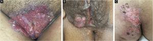 Herpes mucocutâneo crônico: imagens clínicas de três pacientes do sexo feminino apresentando lesões genitais e glútea (A, Caso 3; B, Caso 2; C, Caso 4).