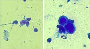 Esfregaço de lesões submetido a coloração por panótico rápido evidenciando células epiteliais multinucleadas, o que sugere inclusão viral por herpes‐vírus, chamadas células de Tzank (400×).