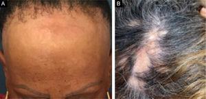 (A), Alopecia frontoparietal e de supercílios com pápulas da face em região frontal (AFF). (B), Áreas de alopecia multifocal em região parietal e vértice (LPP).