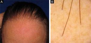 (A), Alopecia frontotemporal em paciente com AFF e ausência de supercílio. (B), Tricoscopia: descamação peripilar discreta e ausência de aberturas foliculares.