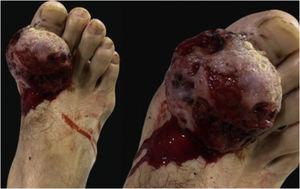 Tumor exofítico, ulcerado, no hálux do pé direito.