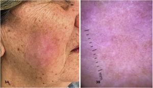 A, Imagem mostrando resolução clínica de LM na face após 12 semanas de tratamento com IQ 5% tópico. B, Dermatoscopia da região tratada mostrando fundo róseo esbranquiçado de caráter pós‐inflamatório.