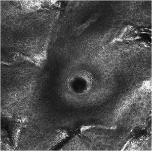Imagem de MRC, 60 dias após tratamento com IQ 5% tópico na face, mostrando ausência de células pagetóides atípicas na epiderme e células dendríticas perifoliculares, com estrutura da epiderme preservada.