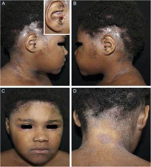 (A‐D), Lesões eczematosas e exsudativas no couro cabeludo, com áreas de alopecia, e escoriações no conduto auditivo externo. Detalhe ampliado do conduto auditivo externo acometido (A). Áreas eritematoedematosas infrapalpebral e lesões eczematosas perilabial (C). Lesões eczematosas na região cervical e retroauriculares; alopecia occipital (D).