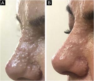 (A) Imagem de perto das lesões de tricoepitelioma localizadas no dorso do nariz. (B) O mesmo local no último seguimento.