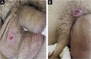 (a) Cancro duro na pele do escroto, note‐se fundo limpo. Paciente também portador de vitiligo. (b) Lesão no púbis, junto à base do pênis de aspecto cupuliforme refletindo a infiltração da base. Note‐se linfadenomegalia regional palpável.