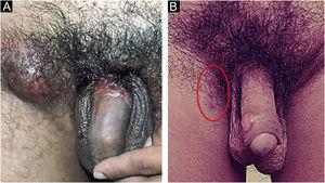 (a) Cancroide: úlceras sem infiltração, serpiginosas e subminadas. Fundo “sujo” e linfadenite inguinal inflamatória, dolorosa e geralmente unilateral. (b) Úlceras por reinoculação. Fotos: Prof. Sinésio Talhari.