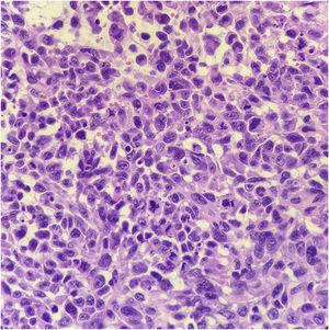 Melanoma exibindo células com atipias, pleomorfismo, nucléolos evidentes e frequentes figuras de mitose (Hematoxilina & eosina, 400×).