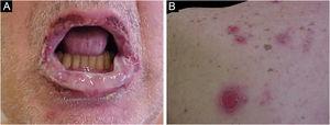 Pênfigo paraneoplásico. (A) Erosões em toda superfície de vermelhão labial. (B) Exulcerações no dorso alto similares a lesões de pênfigo vulgar.