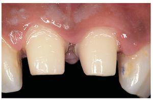 Efecto de la curvatura de la línea de acabado sobre el ajuste marginal ...