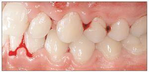 Índices Aplicados En La Profilaxis Y El Tratamiento Periodontal ...