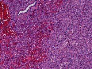 Unusual cause of haemoptysis: Inflammatory myofibroblastic tumour of ...