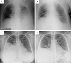 Combined intrapleural therapy in infectious pleural effusion | Pulmonology