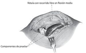 Técnica «extension First» En La Artroplastia Total De Rodilla ...