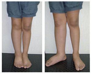 Congenital vascular malformations update | Medicina Universitaria