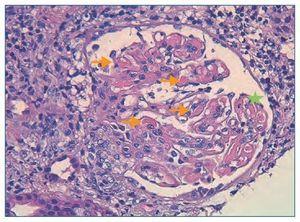 Glomerulonefritis Rápidamente Progresiva: A Propósito De Dos Casos ...