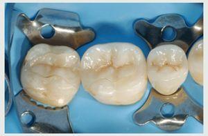 Reconstrucción De Dientes Posteriores Tratados Con Endodoncia -¿con O ...