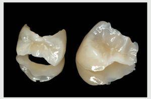 Reconstrucción de dientes posteriores tratados con endodoncia -¿con o